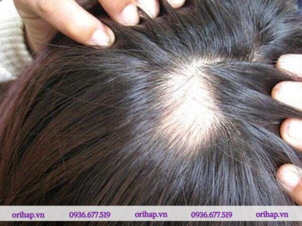 Bệnh nhân thường tập trung nhổ tóc tại một vùng cụ thể, gây ra các mảng trụi tóc rõ rệt